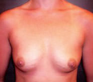 Breast Augmentation Results Newark