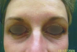 Under Eye Rejuvenation