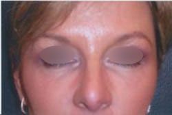 Under Eye Rejuvenation