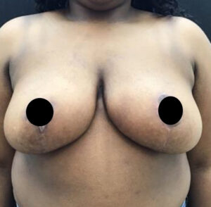 Breast Reduction