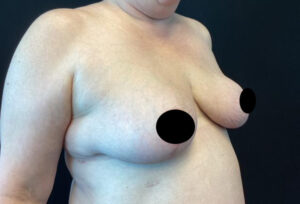 Breast Reduction