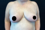 Breast Reduction