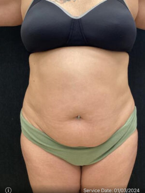 Tummy Tuck