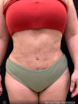 Tummy Tuck